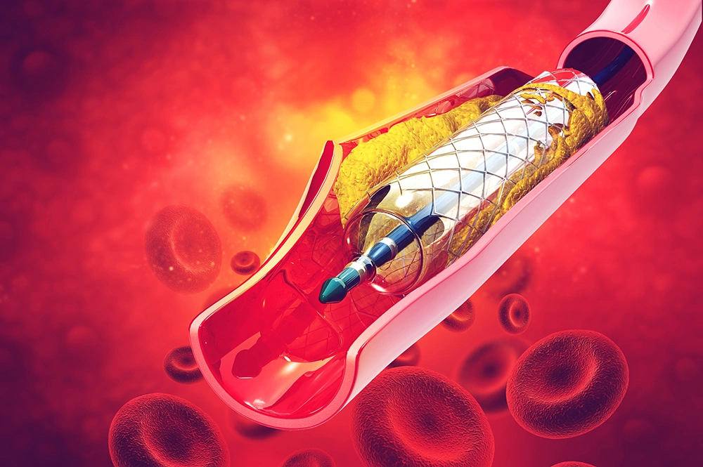 Balloon angioplasty procedure inside a blood vessel